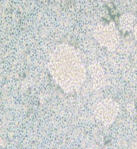 Reh人急性非B非T淋巴細(xì)胞白血病主圖